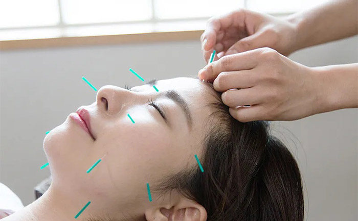 鍼灸治療・美容鍼